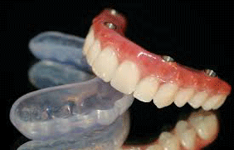 手術用マウスピースで安全にインプラントを埋入