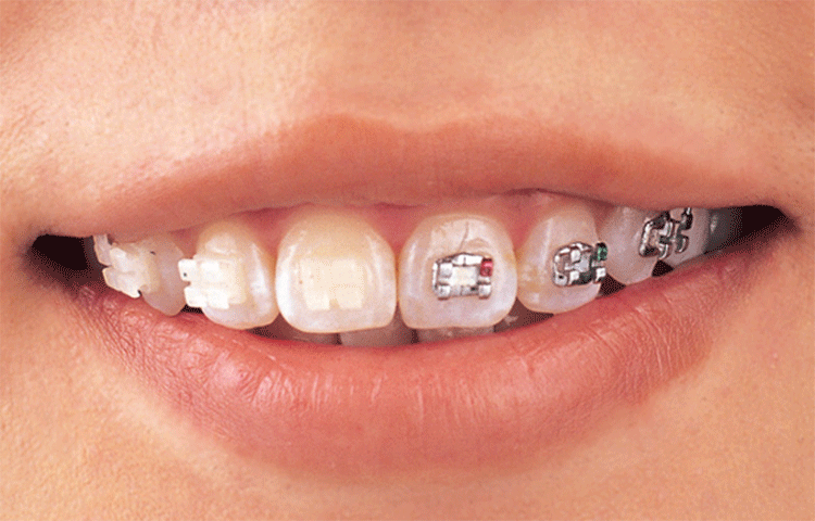 マウスピース矯正
